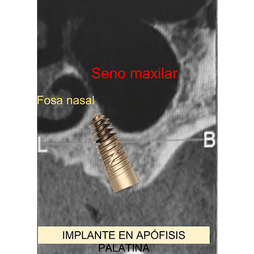 tecnicas-implantologicas-conservadoras_02