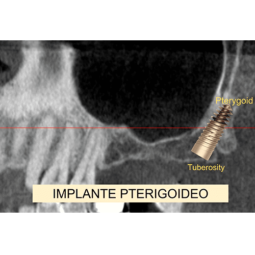 tecnicas-implantologicas-conservadoras_03