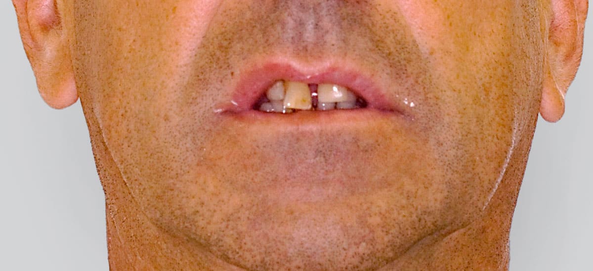 ANTES